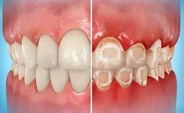 Before-and-after example showing decalcified white spots on teeth, the kind Icon treats